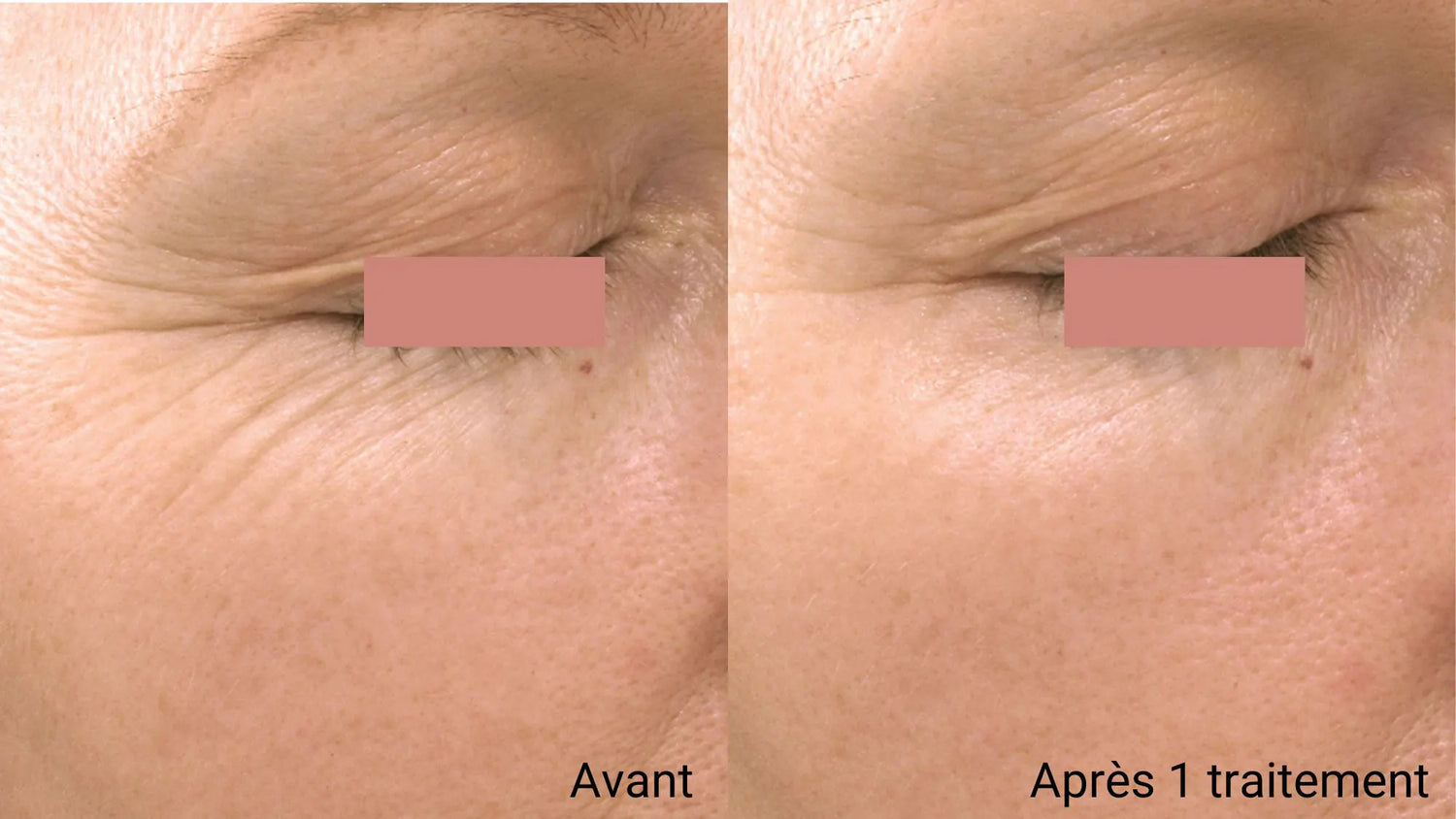 Soin Peeling Professionnel