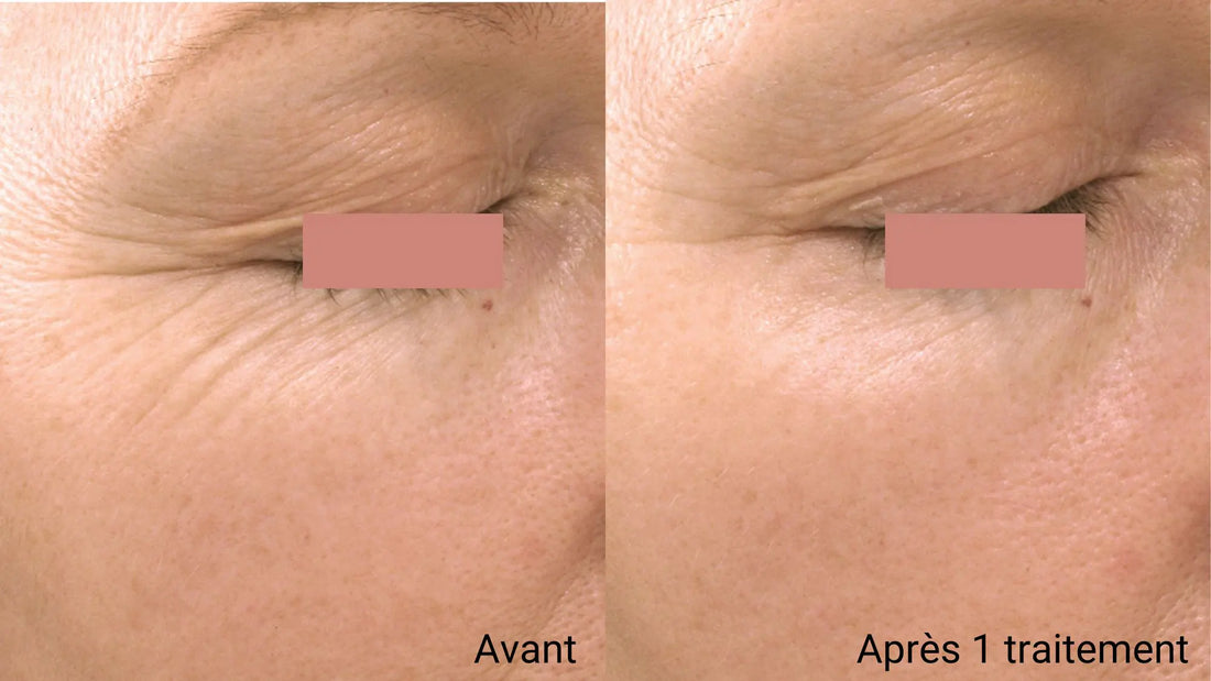 Soin Peeling Professionnel